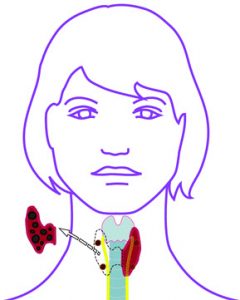 Abbildung Hemithyreoidektomie