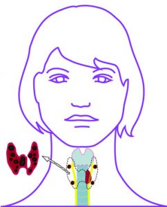 Abbildung OP nach Dunhill