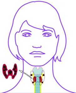 Abbildung beidseits subtotale Resektion