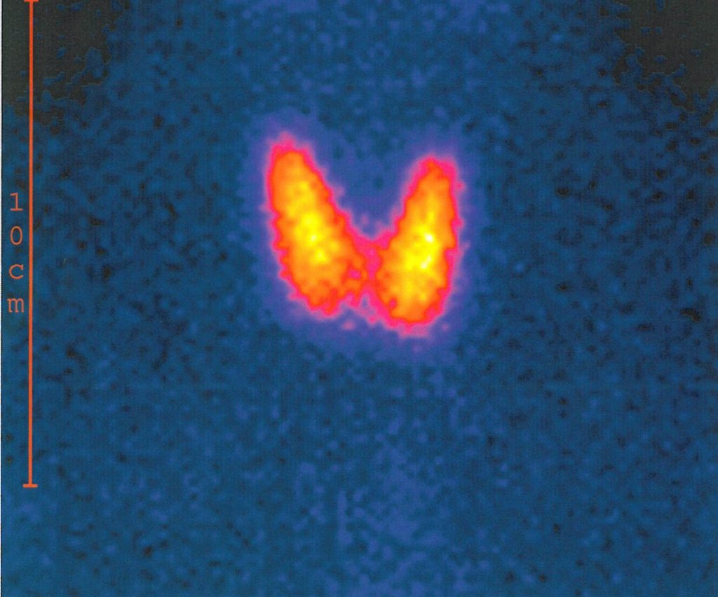 Normales Schilddrüsenszintigramm