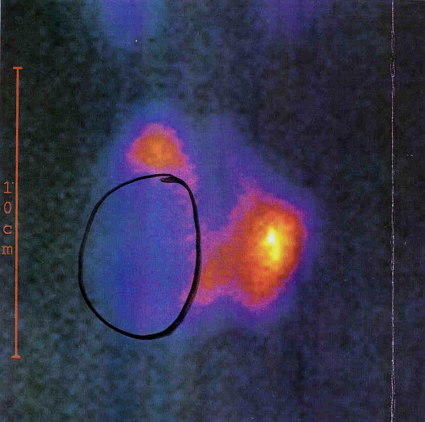 Szintigramm mit großen kalten Knoten