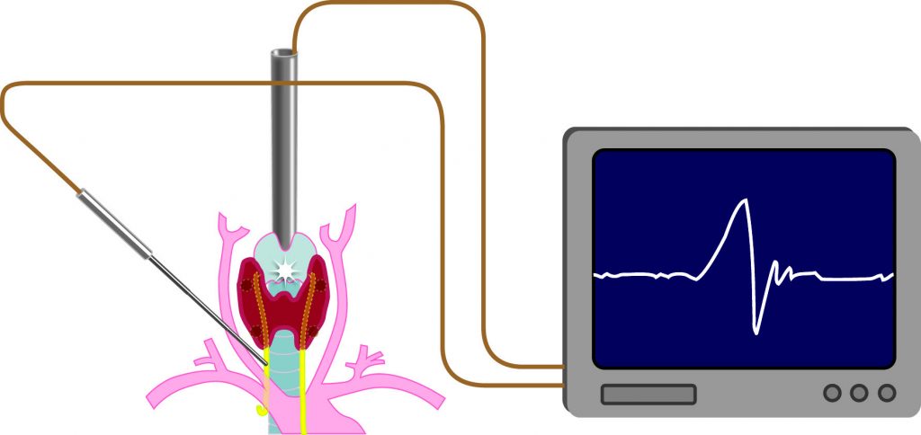 Abbildung intraoperatives Neuromonitoring