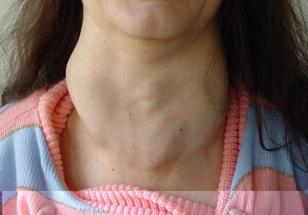 Patientin mit Struma