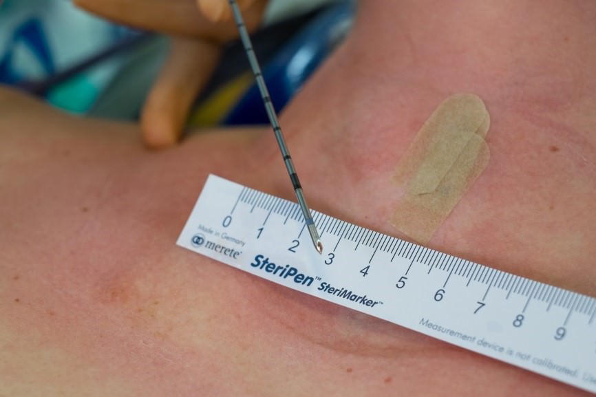 Sonde nach erfolgter Thermoablation
