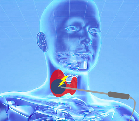 Schematische Darstellung Thermoablation